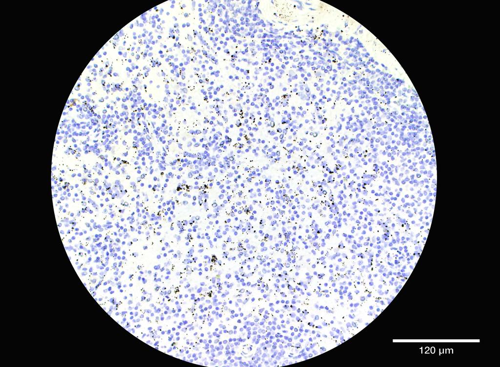 Ankyron ADA19_HUMAN Clone FU40572