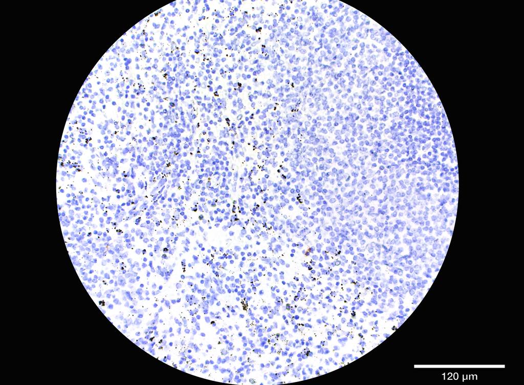 Ankyron ADA23_HUMAN Clone FU40118