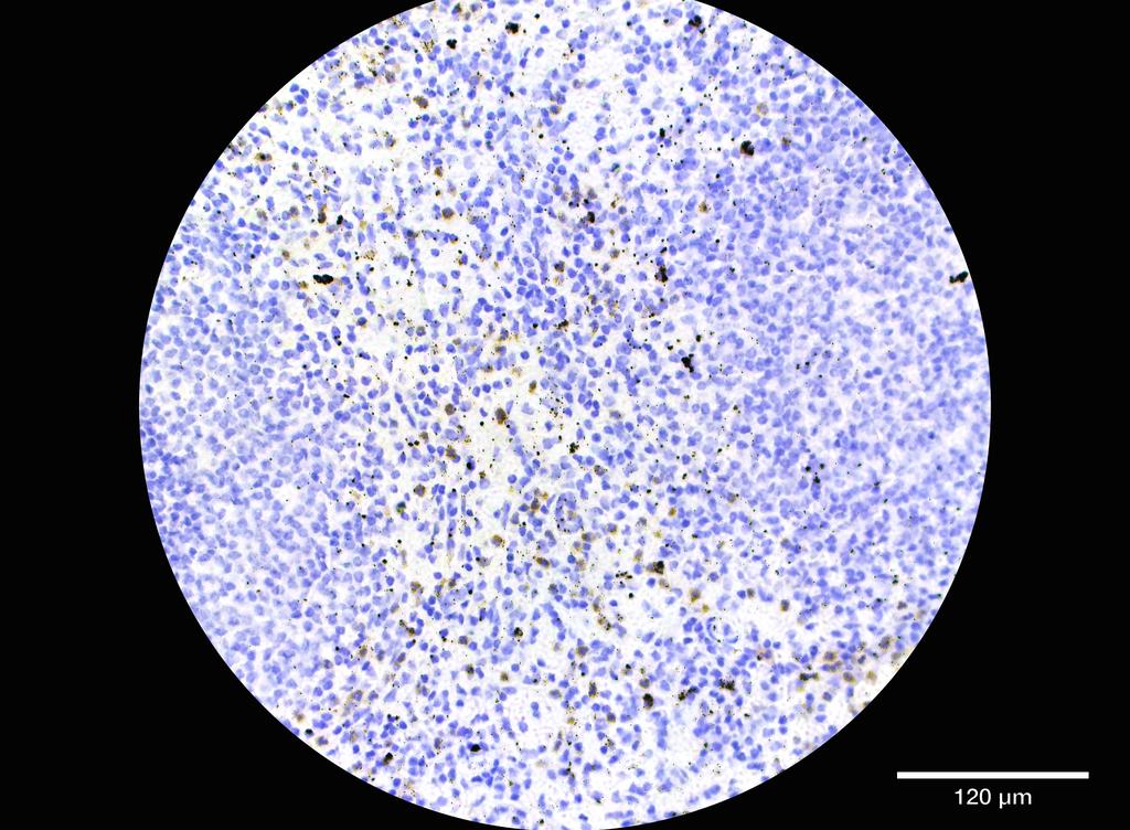 Ankyron MMP25_HUMAN Clone GF40270